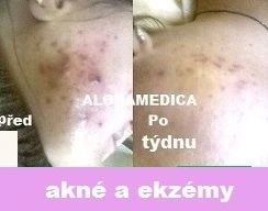 Ošetření Akné a podrážděná pleť